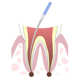 根の治療（根管治療）