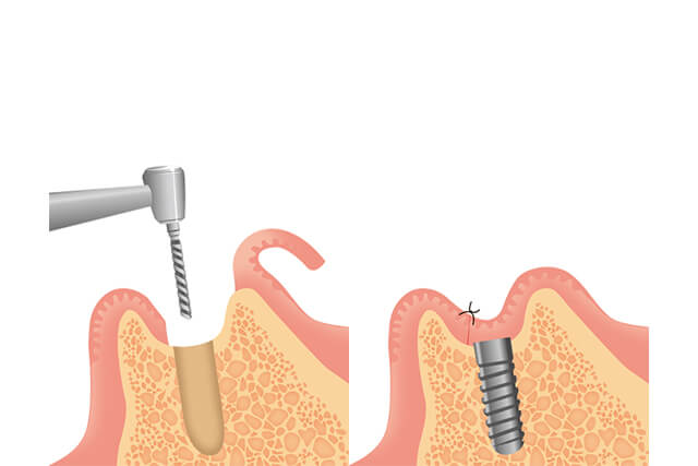 インプラント埋入手術